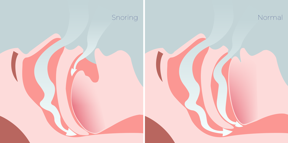 Snoring and normal airway